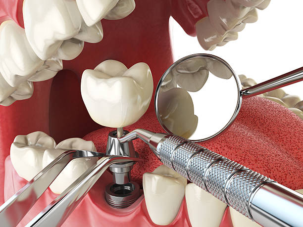 Best Emergency Treatment for Toothache in Alpharetta, GA